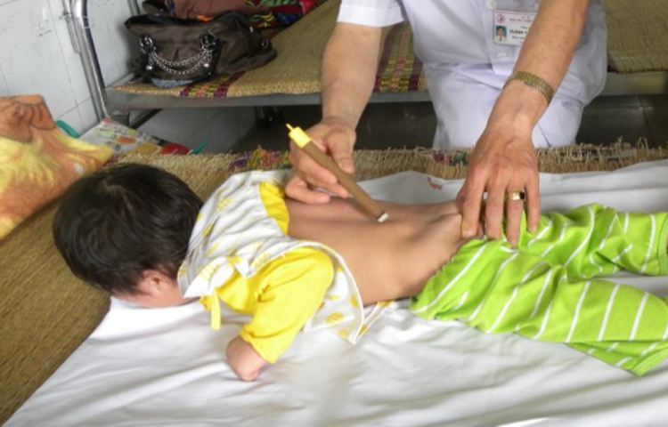 Cứu điều trị đái dầm